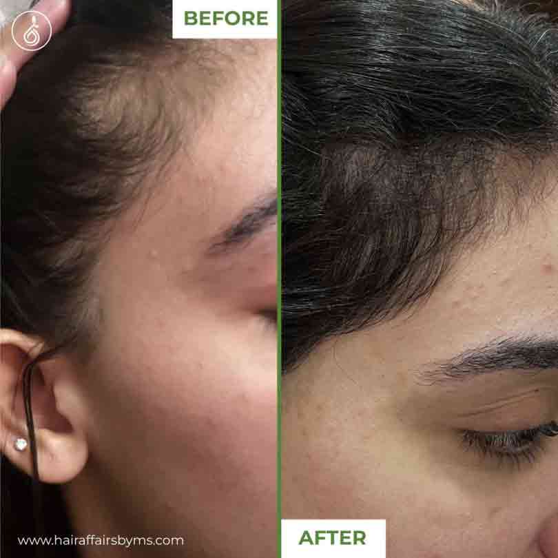 ✨ گھنے بالوں کے لیے ڈرما رول ✨ Derma Roller
💆‍♂️ Hair Growth & Skin Care Solution